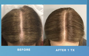 Alma TED Hair Restoration